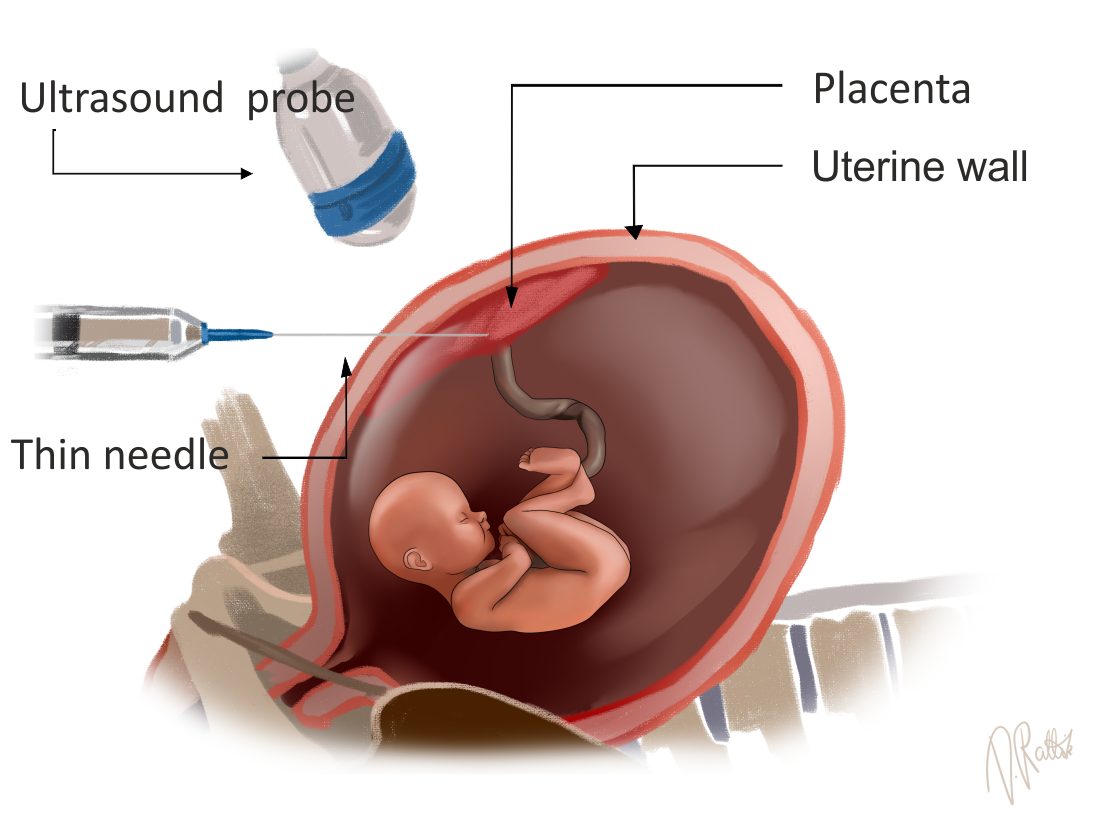 chorionic villus sampling