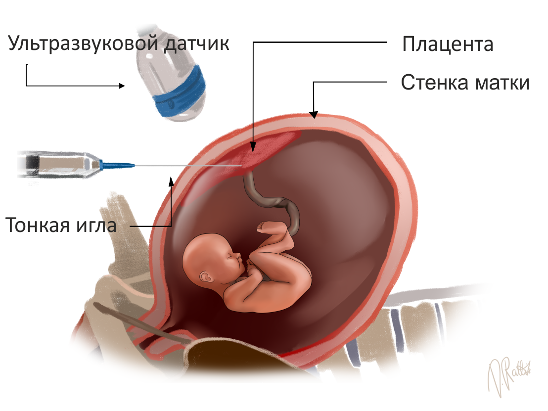 Биопсия хориона