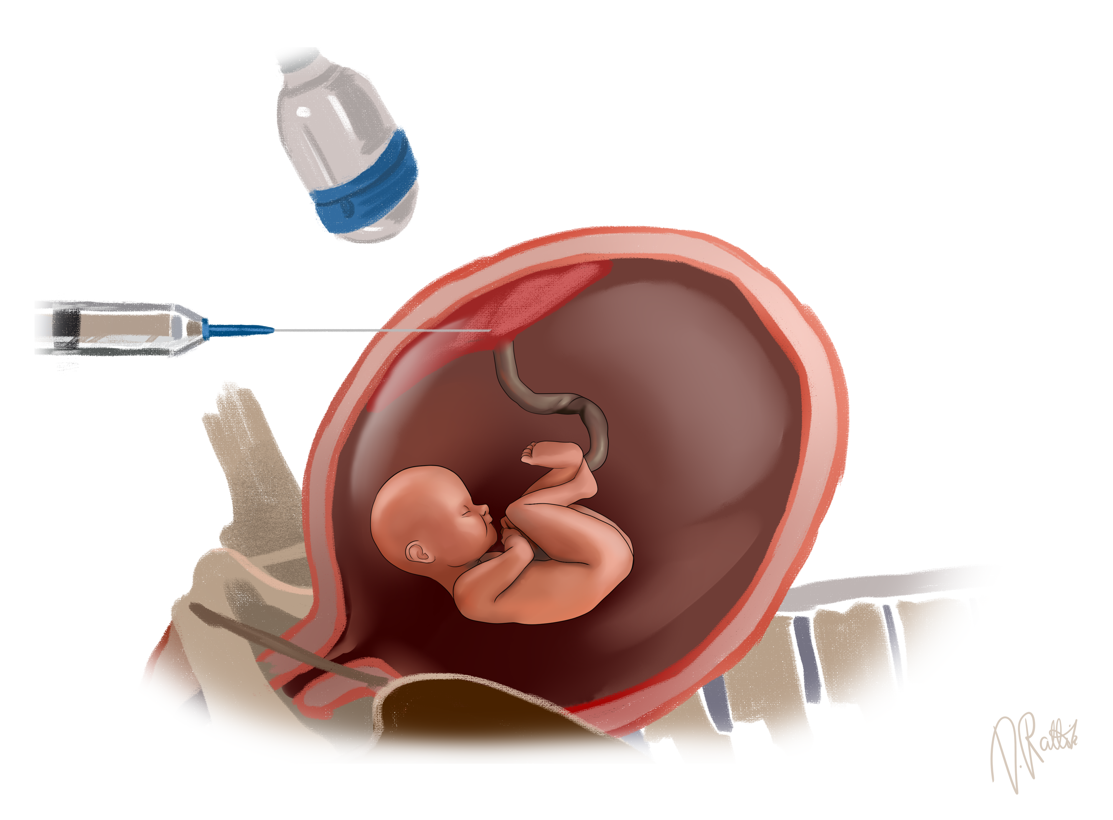 Chorionic villus sampling