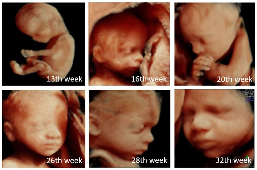 3D ultrasound scan of the fetus