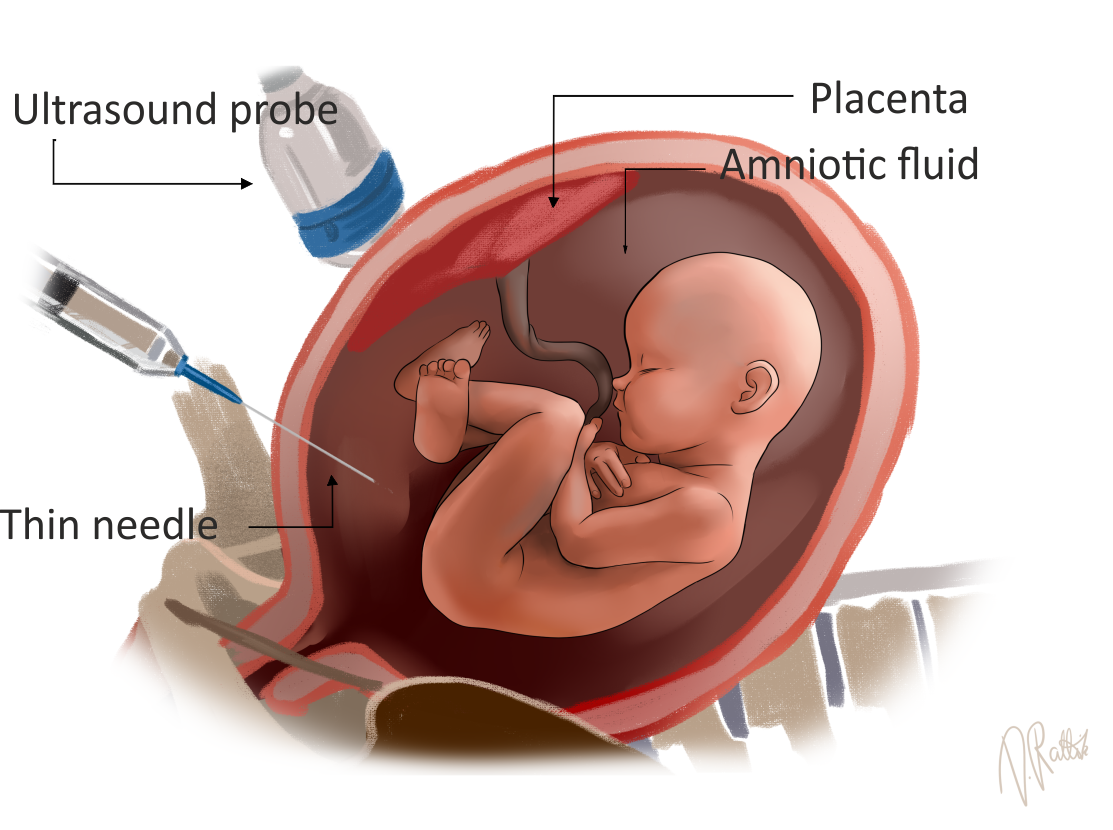 Amniocentes