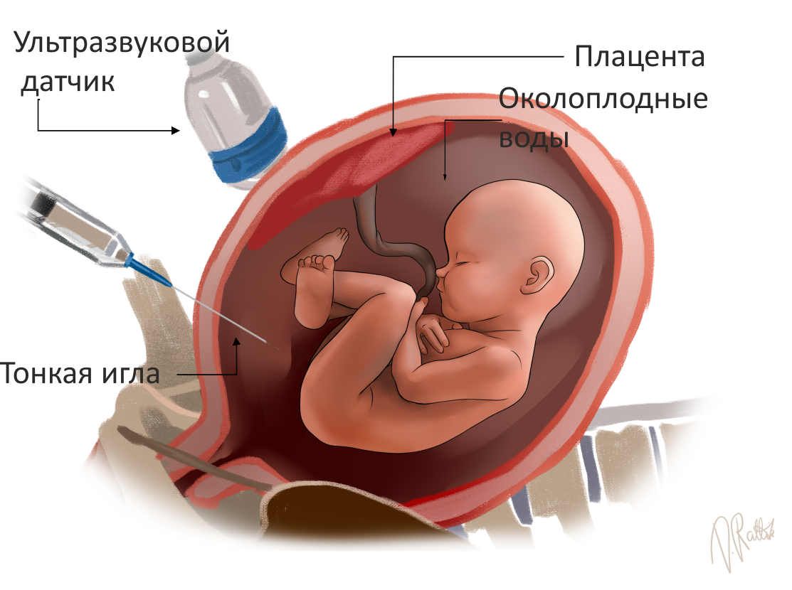 Амниоцентез