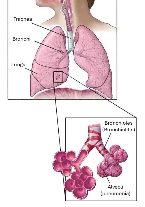 RSV infection