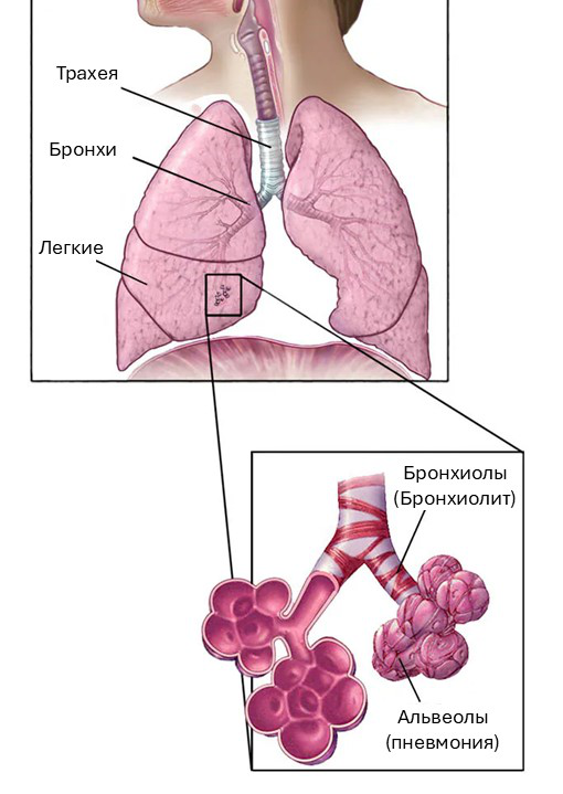 РСВ-инфекция