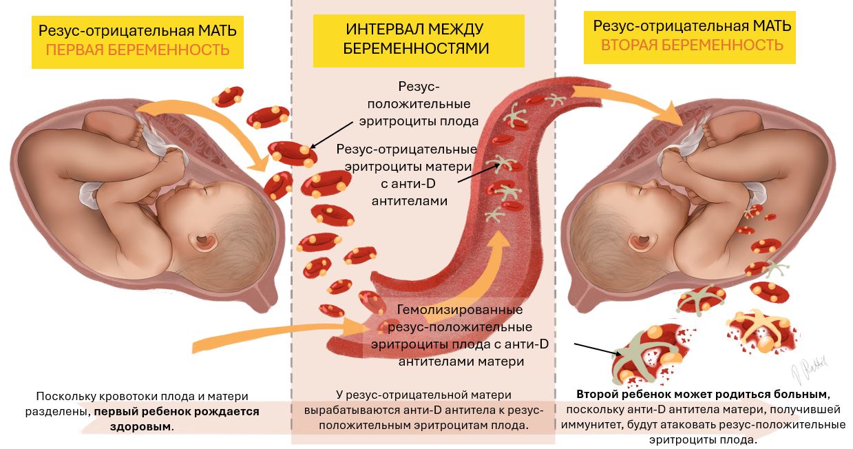 резус-конфликт