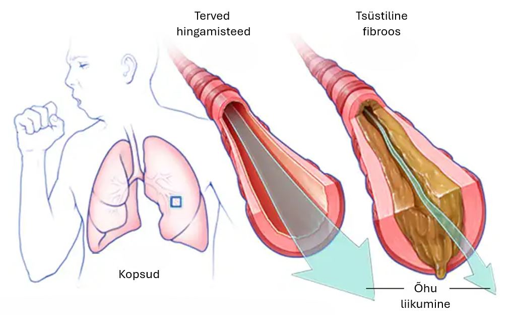 Tsüstiline fibroos