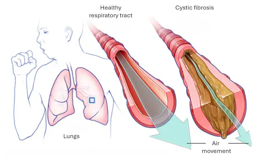 Cystic fibrosis
