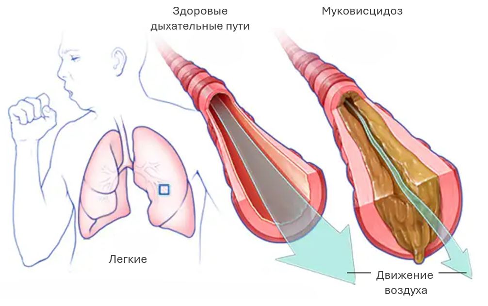 Муковисцидоз