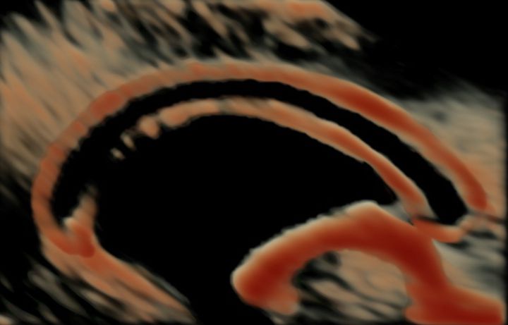 Loote aju corpus callosumi hindamine rasedusaegse eksperthinnangu käigus