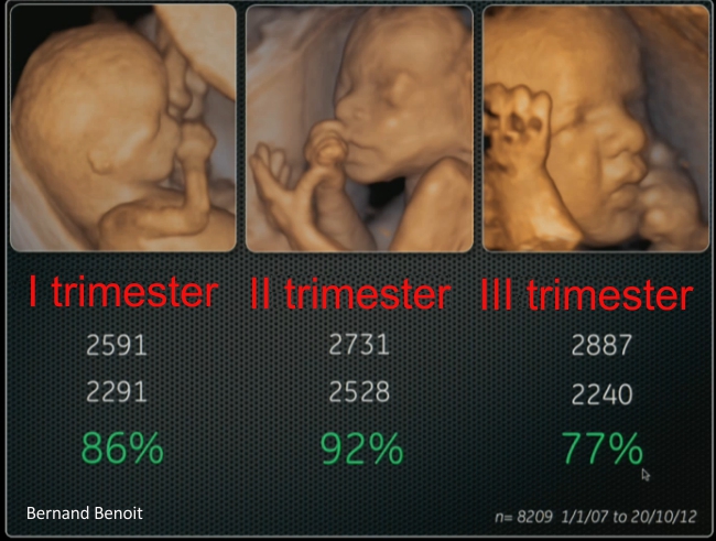 Successful 3D/4D ultrasound picture
