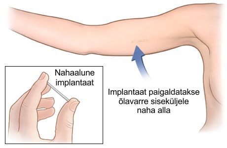 Nexplanon