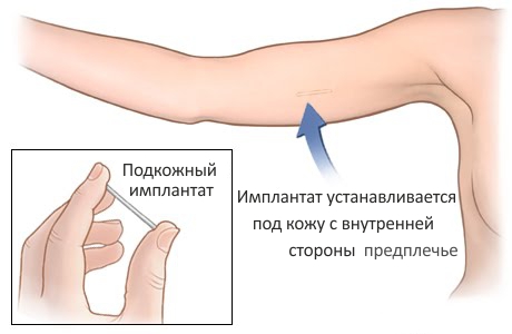 Фото Спирали Против Беременности